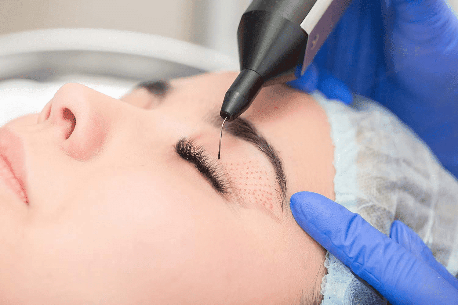 Tratamiento de plasma pen en iderma: especialista aplicando plasma pen en el párpado de una cliente. Servicios de belleza avanzados en Murcia, Alicante y Orihuela para rejuvenecimiento facial no invasivo.